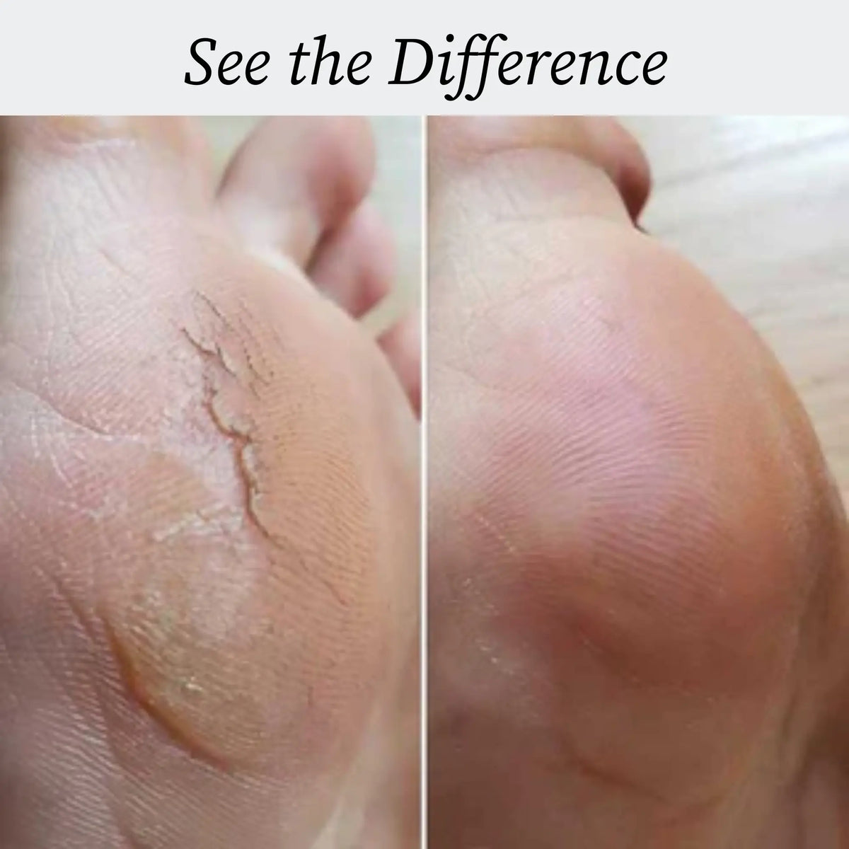 Moravo Callus Remover